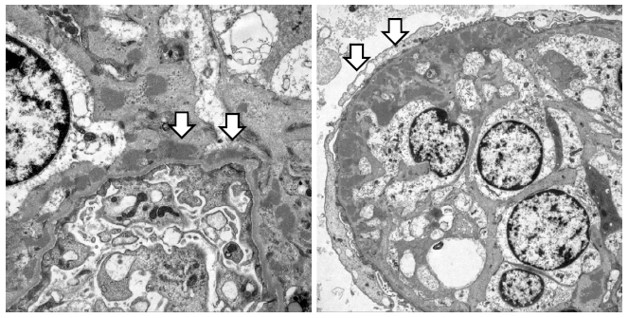 Publication thumbnail: Vasculitis IgA como Efecto Adverso de Tofacitinib en Artritis Reumatoide